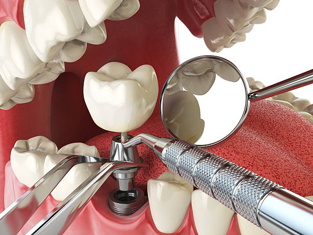 Best Emergency Dentist for Lost Fillings or Crowns in Orida Ridge, FL
